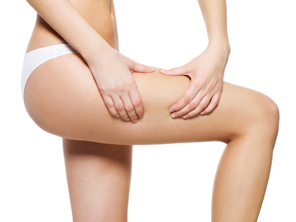 mujer-aprieta-piel-celulitis-sus-piernas